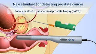 Transperineal Prostate Biopsies Under Local Anesthesia [upl. by Kolk]