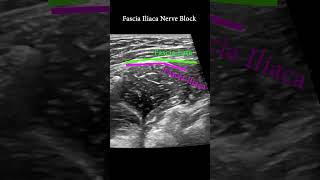 Fascia Iliaca Plane Block ultrasound nerveblock anatomy [upl. by Marcellina]