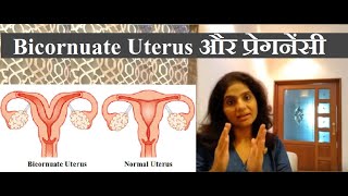 Bicornuate Uterus एक ठोस वजह गर्भ धारण न होने की  Bicornuate Uterus Treatment [upl. by Jed]