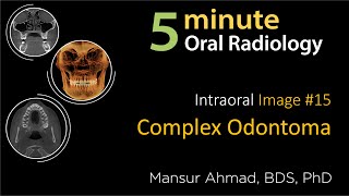 Complex Odontoma Intraoral Radiographic Interpretation [upl. by Newhall739]