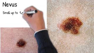 Nevus  Moles Which nevi are dangerous Freckles and moles are the same [upl. by Uticas]