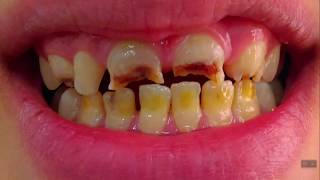 enamel hypoplasia vs hypomineralization [upl. by Jolda]