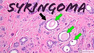 Syringoma 5Minute Pathology Pearls Tadpole  Paisley Tie Pattern Dermpath Dermatology [upl. by Midian]