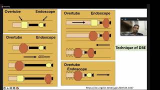 Endoscopy lectures Enteroscopy amp Polypectomy [upl. by Leur]