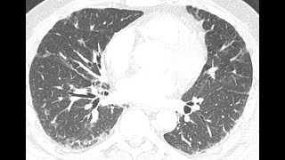 STR Cardiothoracic Case Webinar 3182021 [upl. by Idnam508]