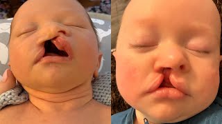 Judahs Story Transformation Through Nasoalveolar Molding NAM and Cleft Lip Surgery [upl. by Tavi]