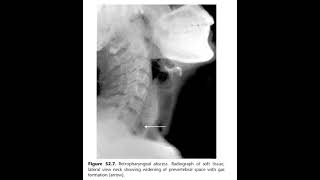 Acute retropharyngeal abscess [upl. by Eninej628]