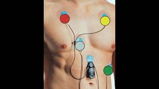 Holter monitoring II noninvasive procedure II cardiovascular disease II nursing II medical study II [upl. by Harehs]