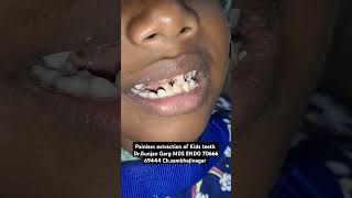 extraction of kids teeth without injection drgunjangarg kidsdentistinaurangabad kidsteethspecial [upl. by Snashall]