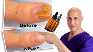 1 Oil Cures Toe Nail Fungus  Dr Mandell [upl. by Auoy]