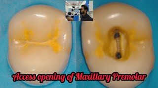 Access opening of Maxillary Premolar step by step root canal demonstrationrct for beginners [upl. by Juieta]