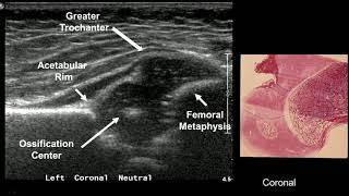 Imaging in developmental hip dysplasia [upl. by Anaibaf311]