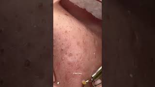 Remove ACNE FAST With These Treatment Secrets dermatologia acne blackheads [upl. by Adnilram]