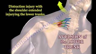 Brachial Plexus Mechanism Of Injury  Everything You Need To Know  Dr Nabil Ebraheim [upl. by Noislla]