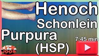 Henoch Schonlein Purpura HSP ׀ Basic necessary facts amp management ׀ Made easy  dr joos [upl. by Bethina263]