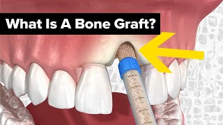 Dental Bone Grafts Explained [upl. by Malissa]