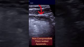 When Appendix becomes Infected and Complicated ultrasound appendicitis intestine [upl. by Terhune]