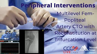 Multilevel FemPopliteal Artery CTO with Reconstitution at Trifurcation Level [upl. by Ahto716]