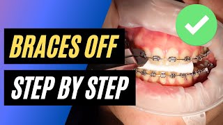 BRACES OFF  Step by step orthodontic removal [upl. by Wojcik396]