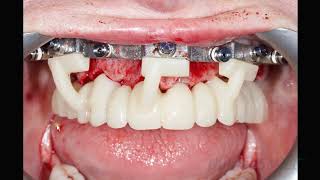 GuidedSMILE Dentate Natural Maxillary  Hamill [upl. by Emyle]