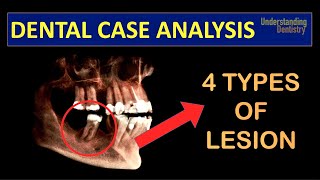 TRY TO DIAGNOSE A Case with 4 TYPES of PERIAPICAL LESIONS radicular cyst close to IAN Dental Quiz [upl. by Trstram]