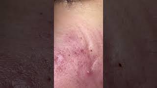 Big Cystic Acne Blackheads Extraction Blackheads amp Milia Whiteheads Removal Pimple Popping shorts [upl. by Ashly277]