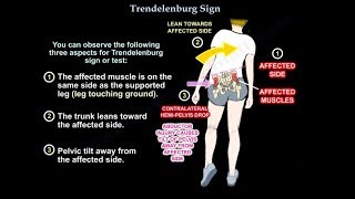 Trendelenburg Sign  Everything You Need To Know  Dr Nabil Ebraheim [upl. by Lehctim]