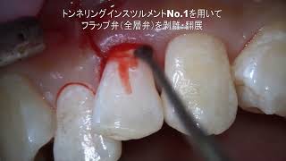 マイクロスコープを用いた低侵襲歯周組織再生療法 EPPT （Entire Papilla Preservation Technique） [upl. by Nereen580]