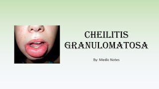 Cheilitis granulomatosa  causes signs amp symptoms investigation treatment [upl. by Deehahs]