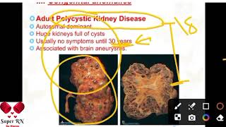 افضل شرح لتكيسات الكلي المتعدده  Polycystic Kidney Disease Adult and Childhood [upl. by Amelus524]