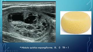 ECOGRAFIA DE TIROIDES EVALUACION DE NODULOS APLICACION TI RADS [upl. by Dnalevets]