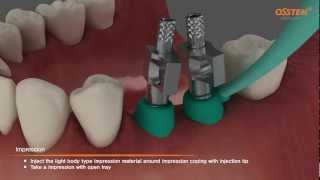 TSIII Fixture Placement amp Impression taking Pickup and Transfer Impression Copings [upl. by Ennaeel]