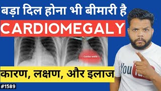 दिल का बड़ा होना भी बीमारी है  Cardiomegaly Causes Symptoms And Treatment [upl. by Morton]