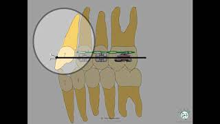 Biomechanics 3how to achieve various tooth movements [upl. by Nohtahoj]