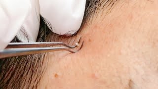 ASMR INGROWN  Whiteheads Face Extractions Treatment  soft whispers  allzoomed [upl. by Gnilhsa838]