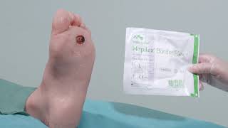 Mepilex Border Flex  Application on Foot [upl. by Cahra]