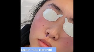 Laser Mole Removal  London Skin Clinic [upl. by Holleran663]