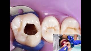 Dental fillings  Restoring decayed teeth [upl. by Moitoso58]