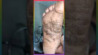 पैरो के तलवे की चमडी का रोग plantar keratoderma viralshorts [upl. by Tillio]