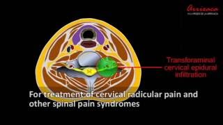 CERVICAL EPIDURAL TRANSFORAMINAL INFILTRATION Cervical radicalar block [upl. by Dloraj]