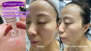 Picosecond Laser for Acne Scars amp Hyperpigmentation Before amp After  Erasing Your Acne Scars  AS60 [upl. by Vashtia]