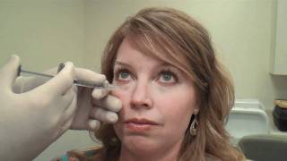 Juvéderm™ Tear Trough Treatment Huntsville Alabama  Dr David L Durst [upl. by Rubia]