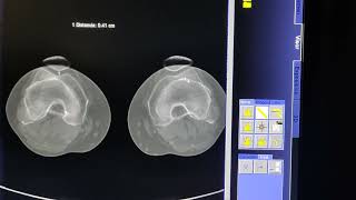 CALCULO DE TUBEROSIDAD TIBIAL EN TOMOGRAFIA [upl. by Onnem]