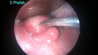 Retropharyngeal Abscess [upl. by Akirahs]