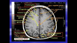 radiological anatomy of the brain part I [upl. by Lief909]