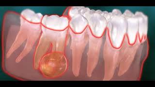 Abcès endodontique dentaire kyste [upl. by Burrow480]