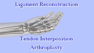 The Anchovy Procedure for Thumb Basal Joint Arthritis [upl. by Risser]