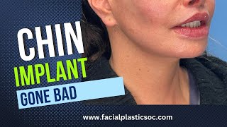 Chin Implant complications What can go wrong Chin ptosis Lip incompetence [upl. by Arbe321]