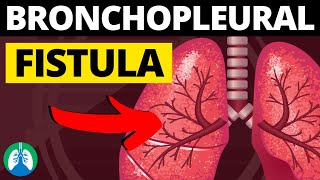 Bronchopleural Fistula Medical Definition  Quick Explainer Video [upl. by Nogas]