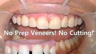 No Prep Dental Veneers Non Prepped Laminates in Korea No Cutting [upl. by Eckhardt472]